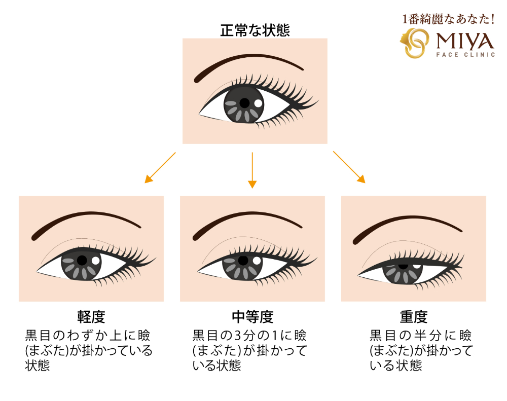 眼瞼下垂症の程度