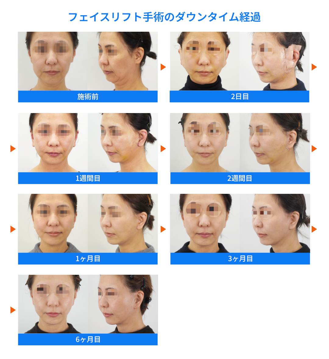 フェイスリフトのダウンタイム経過