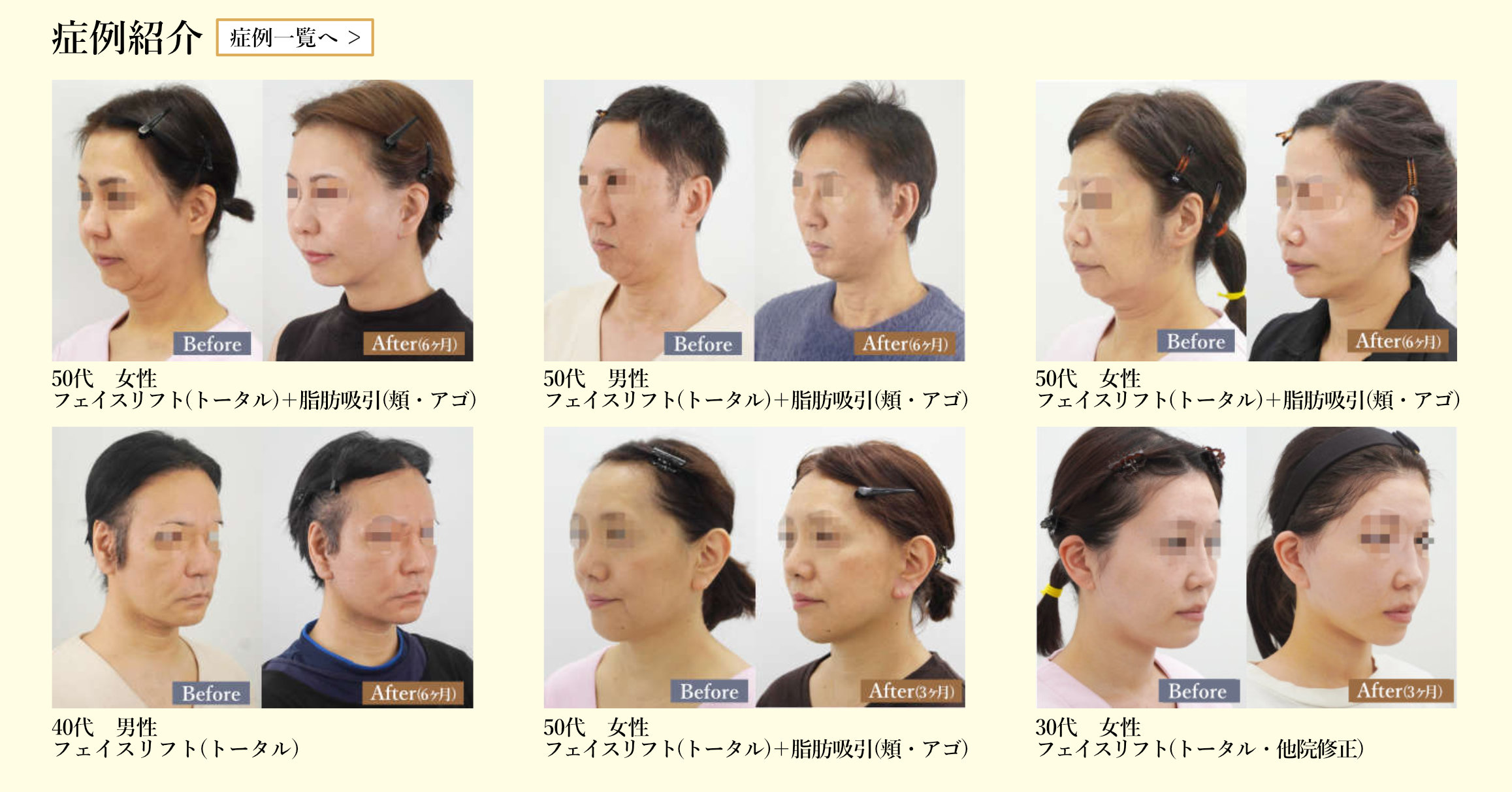 フェイスリフト症例一覧